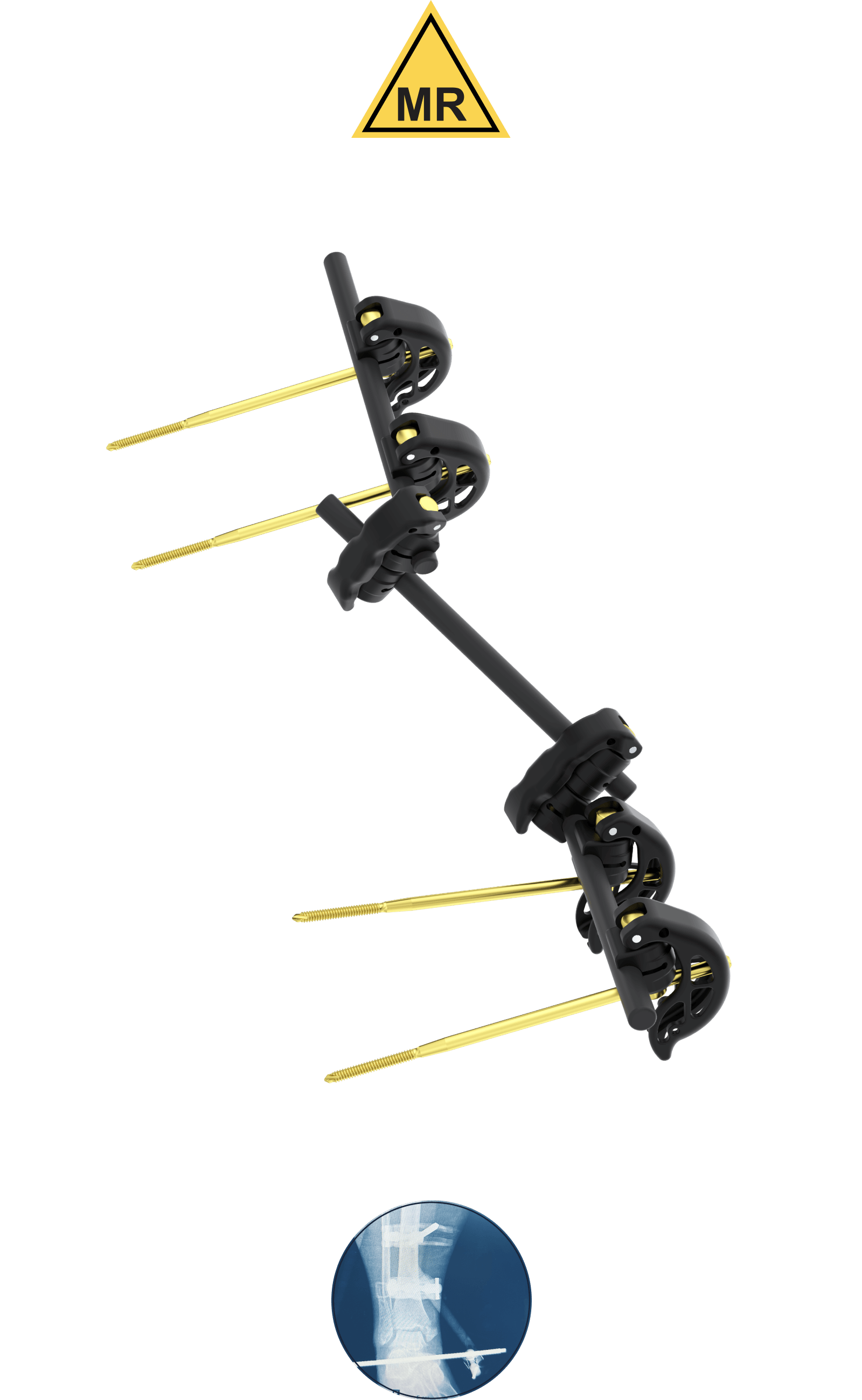 Temporary external fixation system | Citieffe